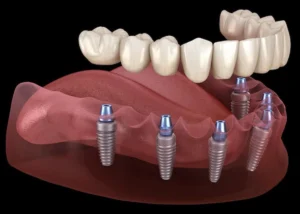 dental implants turkey