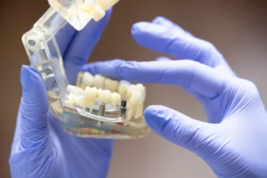 all on 4 dental implants